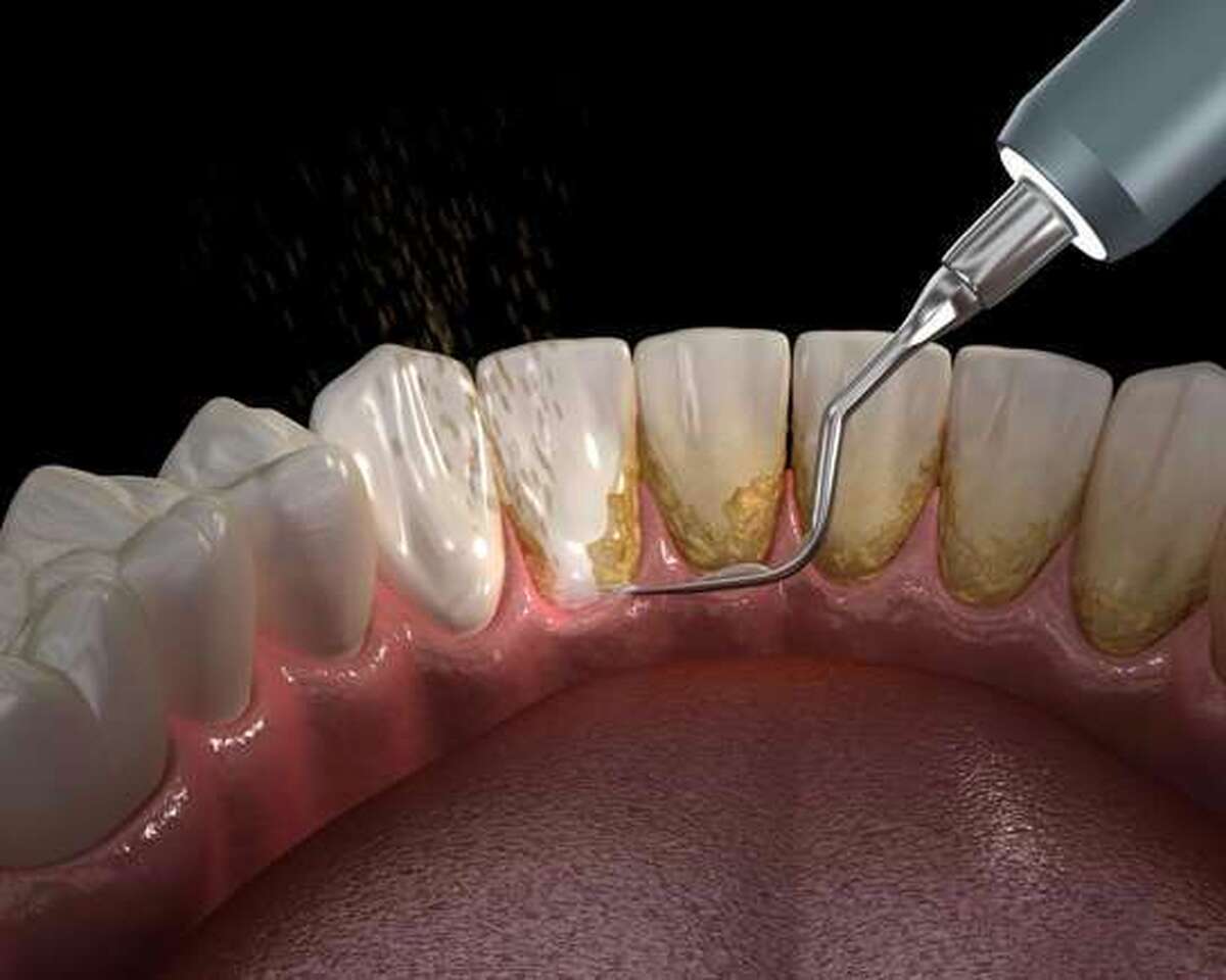 خون‌ریزی لثه نشانه چیست؟