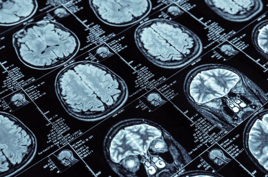 امیدی تازه برای درمان آلزایمر؛ محققان روشی جدید برای ارسال دارو به درون مغز پیدا کردند
