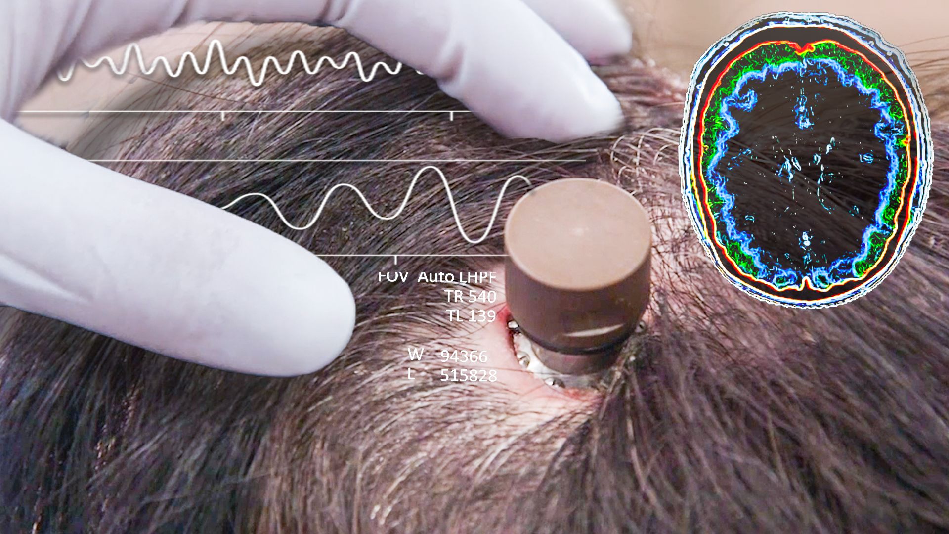 آزمایش ایمپلنت مغز بر روی انسان توسط نورالینک  + فیلم ویدیو
