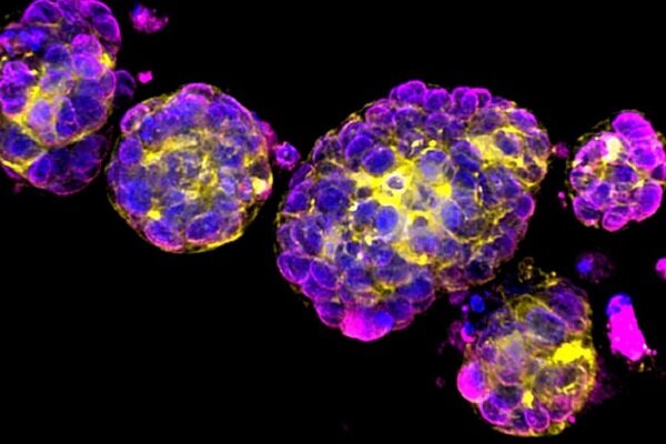 تشخیص محل تومورهای سرطانی با کمک نانو ذرات با روشی ساده و ارزان
