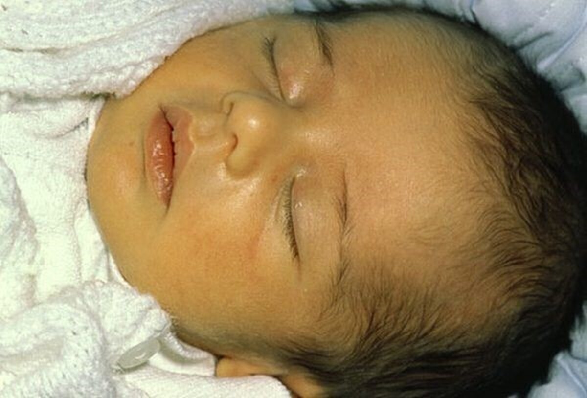 تشخیص بیماری زردی در نوزادان با تتوهای فلورانسی
