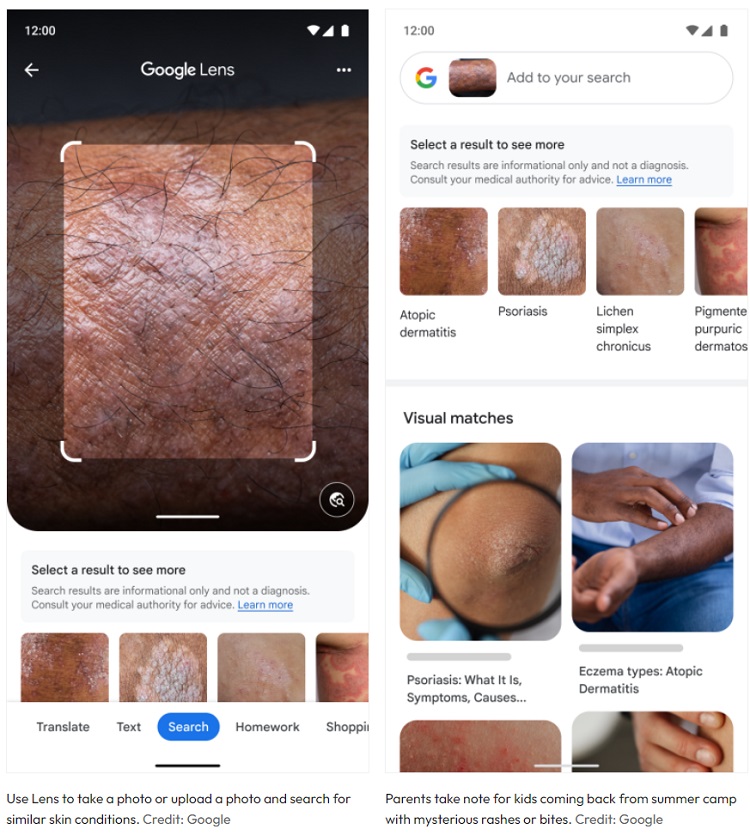 گوگل‌لنز از هوش‌مصنوعی در تشخیص بیماری‌های پوستی استفاده می‌کند
