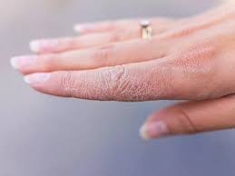 چگونه با خشکی پوست در زمستان مقابله کنیم
