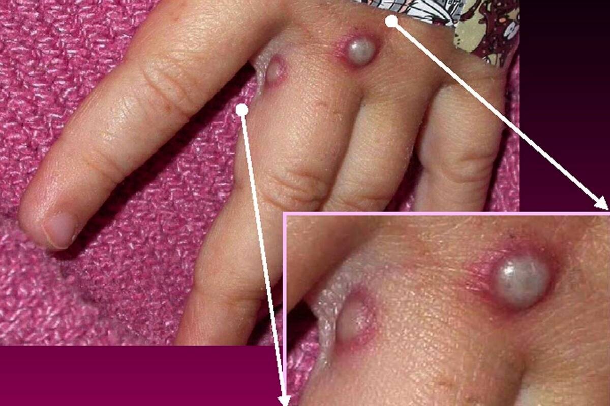 سرعت بالای شیوع آبله میمونی؛ جزئیات تزریق واکسن ام‌پاکس
