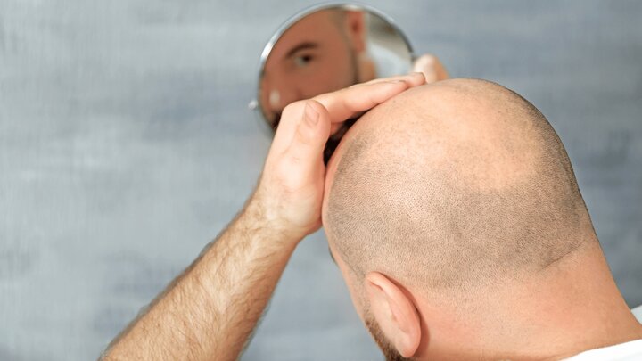 جلوگیری از طاسی؛ راهکار نوین هکر زیستی
