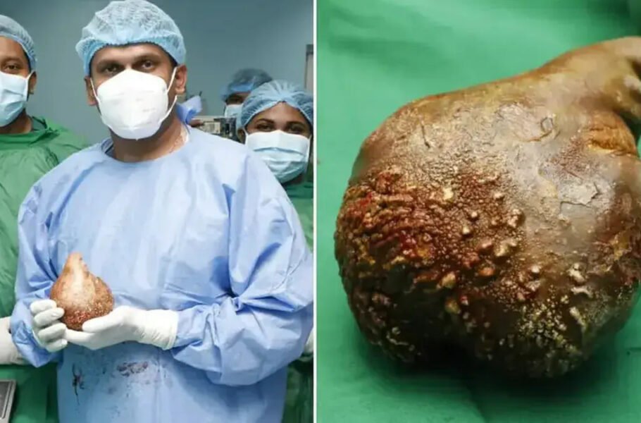 بزرگ‌ترین و سنگین‌ترین سنگ کلیه جهان از بدن یک بیمار با موفقیت خارج شد
